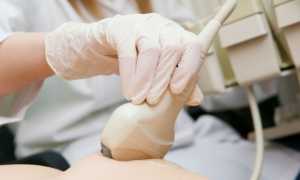 Плотное безболезненное образование или фиброма молочной железы: что это такое и как лечить опухоль состоящую из соединительных клеток