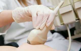 Плотное безболезненное образование или фиброма молочной железы: что это такое и как лечить опухоль состоящую из соединительных клеток