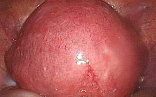 Множественная миома тела матки код по мкб 10