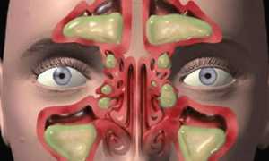 Полипозный этмоидит – симптомы и лечение у взрослых левостороннего