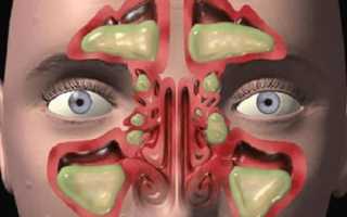 Полипозный этмоидит – симптомы и лечение у взрослых левостороннего