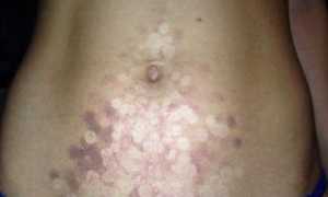 Лазерная, электро и фотоэпиляция. Что лучше? Тест-драйв. Часть 1