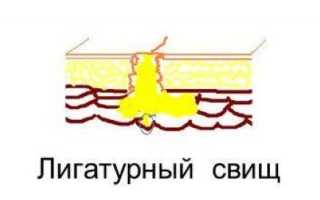 Что такое свищи? Когда они возникают? Современные методы диагностики и лечения