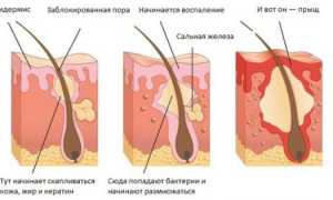 Как убрать прыщи с лица за несколько часов. 4 эффективных способа!