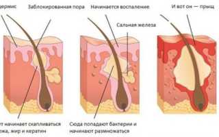 Как убрать прыщи с лица за несколько часов. 4 эффективных способа!