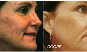 Папулы после биоревитализации – как убрать быстрее