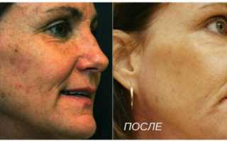 Папулы после биоревитализации – как убрать быстрее
