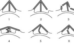 Гипс после ринопластики: руководство по эксплуатации