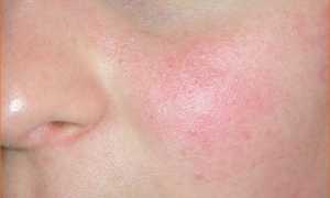 Купероз на лице: эффективное лечение в домашних условиях