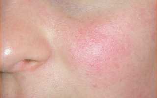 Купероз на лице: эффективное лечение в домашних условиях