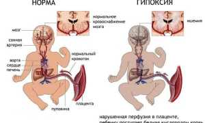 Что такое асфиксия новорожденных: легочные и внелегочные причины развития, врачебная тактика