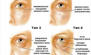 Гравитационный птоз и 7 популярных методов, которые позволят вам «вернуть лицо на место»