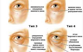 Гравитационный птоз и 7 популярных методов, которые позволят вам «вернуть лицо на место»
