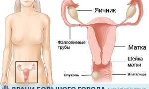 Рак влагалища: причины, виды и способы лечения