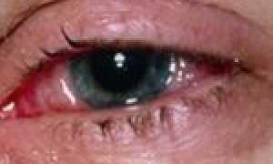 Вирусный конъюнктивит: причины, симптомы и лечение