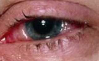Вирусный конъюнктивит: причины, симптомы и лечение