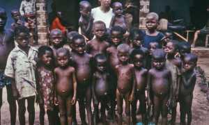 Асцит брюшной полости: причины, виды, симптомы и лечение