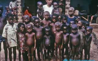 Асцит брюшной полости: причины, виды, симптомы и лечение