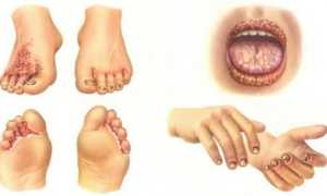 Неходжкинские лимфомы низкой и средней степени злокачественности: грибовидный микоз 