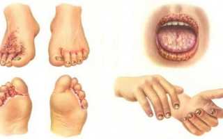 Неходжкинские лимфомы низкой и средней степени злокачественности: грибовидный микоз 