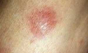 Лимфома кожи: разновидности и признаки злокачественного процесса