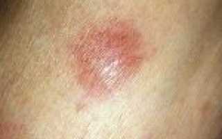 Лимфома кожи: разновидности и признаки злокачественного процесса