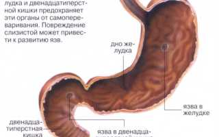 Что делать при обострении язвы желудка и 12-перстной кишки