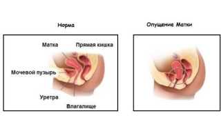 Пролапс матки — как диагностировать и лечить заболевание самостоятельно