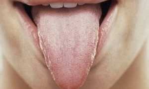 Ромбовидный глоссит: язык в опасности — развеиваем все неясности