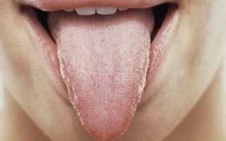 Ромбовидный глоссит: язык в опасности — развеиваем все неясности