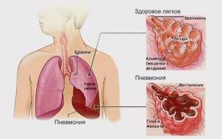 Основные признаки и симптомы пневмонии без температуры у взрослых