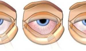 Увеит глаза — что это за заболевание, фото, причины, симптомы и лечение