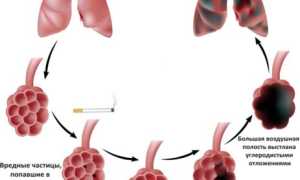 Болезни легких и их симптомы: возможные патологии и их проявления