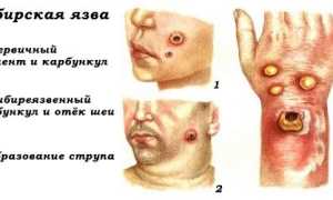 Сибирская язва: симптомы у человека, фото, лечение и профилактика заражения