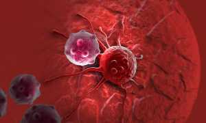 Миеломная болезнь: характеристика опухолей, симптомы, лечение и прогнозы