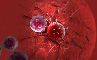 Миеломная болезнь: характеристика опухолей, симптомы, лечение и прогнозы