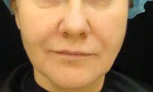 2.2. 2 ступень. Волюмическая коррекция верхней, средней и нижней третей лица. Базовое обучение