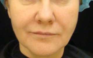 2.2. 2 ступень. Волюмическая коррекция верхней, средней и нижней третей лица. Базовое обучение