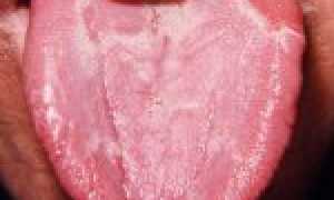 Что делать при ожоге языка и как правильно его лечить?