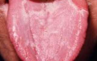 Что делать при ожоге языка и как правильно его лечить?