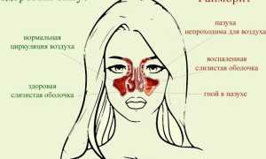 Может ли быть гайморит без насморка, температуры и заложенности носа