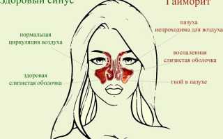 Может ли быть гайморит без насморка, температуры и заложенности носа