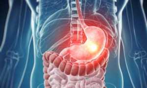 Все о гастрите с пониженной кислотностью — симптомы и способы лечения