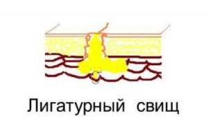 Что такое свищи? Когда они возникают? Современные методы диагностики и лечения