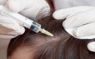 Мезотерапия или плазмотерапия для ухода за волосами: что лучше?