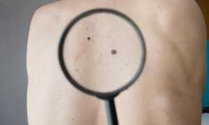 Как выглядят опасные родинки: описание, характеристика, особенности удаления