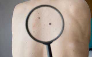 Как выглядят опасные родинки: описание, характеристика, особенности удаления