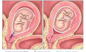 Серкляж шейки матки при беременности — показания, порядок проведения процедуры
