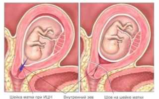 Серкляж шейки матки при беременности — показания, порядок проведения процедуры