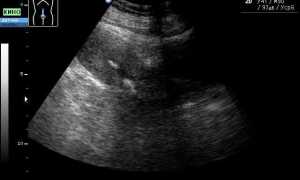 Причины образования кальцинатов в полости матки